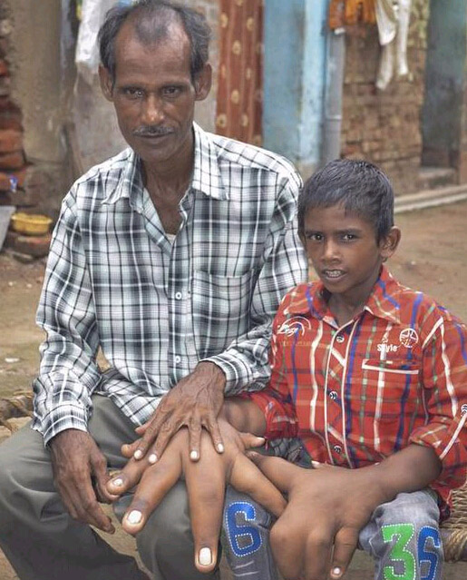 인도 8살 소년 거대한 두손 자라, 무게 12.7kg 초과