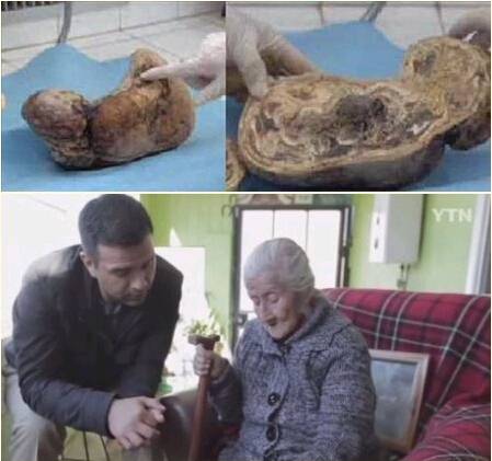 사진설명: 2013년 꼴롬비아의 80대 녀성의 몸에서 발견된 화석태아/ 아르헨띠나 에스텔라 멜렌데스할머니